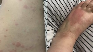 ‘I’ve never been so itchy’: Lara rash hotspots revealed