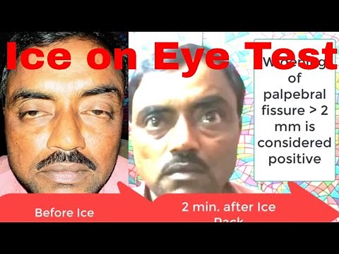 Ice on eye test for myasthenia gravis
