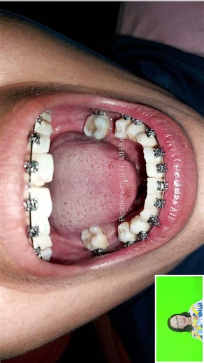 12 MONTHS OF BRACES TREATMENT FOR PROGRESSIVE TEETH AND OVERBITE TEETH AND FAILURE TO FIX BRACES ...