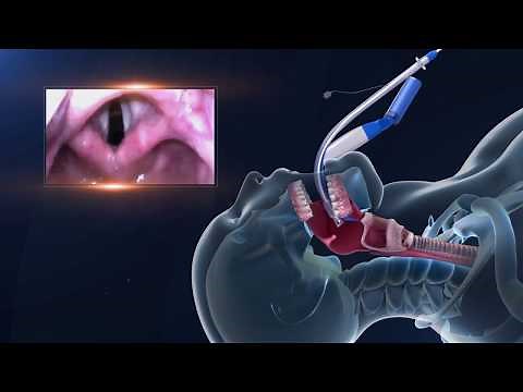 UE Video Laryngoscope Demo