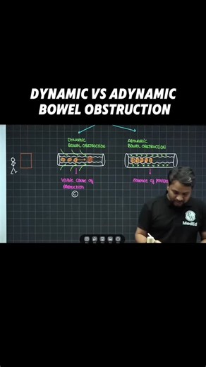 Surgery King on Instagram: "Simple difference between Dynamic & Adynamic Bowel Obstruction . . . #physicswallah #reel @the_surgery_guy"