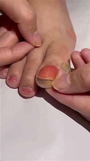 ▶️ Relief starts here Toe Align Ingrown Nail Corrector Stickers ( # 2609 )