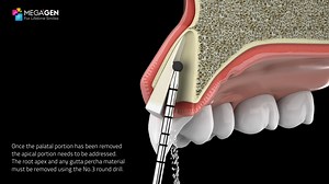 4.6K views · 63 reactions | MegaGen PET Kit - Partial Extraction Therapy Dr Howard Gluckman's Socket Shield Technique kit. #PartialExtractionTherapy #MegaGen #PETkit #AnyRidge #HowardGluckman | MegaGen Implant | Facebook