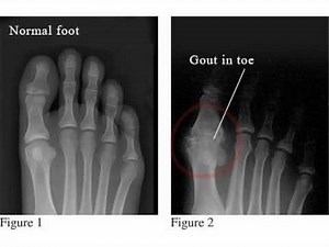How does gout affect your foot?-Minnesota Podiatrist Explains www.innovativefootcare.com