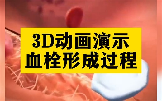 医学动画演示：血栓形成的过程，专业医学解读。