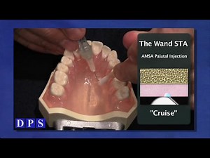 Wand STA AMSA Injection