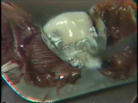 Class V Amalgam Restoration: Cervical Matrix Application