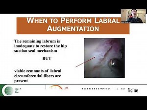 Hip Arthroscopic Management for Labral Tears Repair~ Reconstruction~Augmentation
