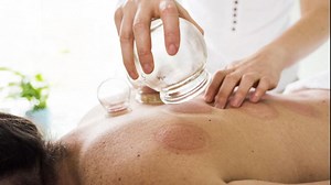 What is cupping?