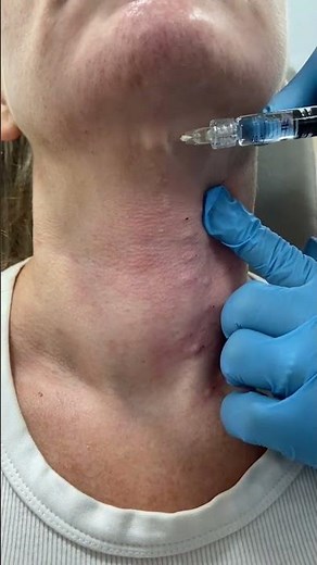 Polynucleotide injections with Dr Berridge | DRMEDISPA