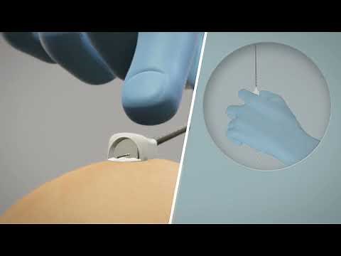 Rocket Medical Copeland Fetal Scalp Electrode