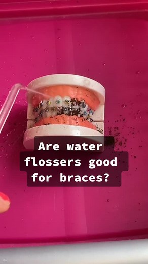 Water Flossing for Braces: What You Need to Know