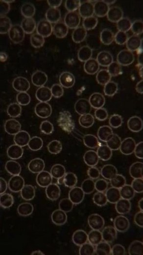 My blood darkfield microscope, spirochete lyme disease