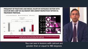#ShockwaveIVL is hard on hard and soft on soft. A recent cadaveric...