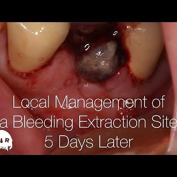 Figure 8 Suture with Collagen Plug and Tranexamic Acid for a Bleeding Extraction site 5 Days Later