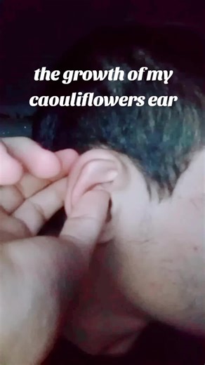 #mma #foryou #fy #cauliflower #cauliflowerear #fypシ