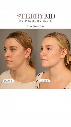 Dr. Thomas Sterry MD FACS on Instagram: "Subtle changes, stunning results. 💫 A mini neck lift is designed to smooth and tighten the lower face and neck, restoring a sharper jawline and a more youthful contour—without the downtime of a full lift. Sometimes, it’s the smaller refinements that make the biggest difference! #drsterry #plasticsurgery #jawline #recovery #mininecklift"
