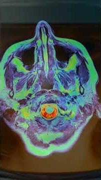 Astronaut Brain Shifts in Space | MRI Study Reveals Microgravity Effect! #shorts #brain