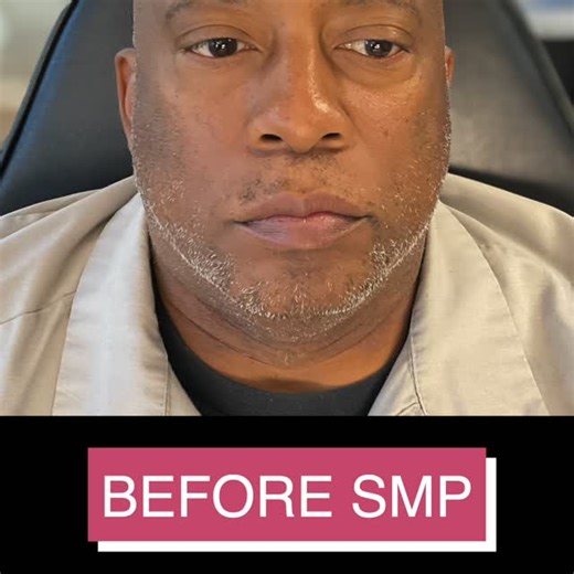 Scalp Work Studio on Instagram: "The 5 o’clock shadow look you always wanted. Say goodbye to the patchy look! #HairLoss #Beard #Barber #Men #HairLossSolutions."