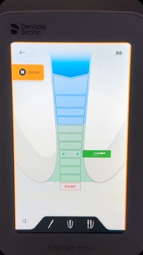 Best Endo motor I’ve used ever X SMART PRO PLUS What I like about it. - the integrated aped locator mode so the finishing file preps to a perfect length and so the cone fit is also perfect - the ability to increase the speed to 3000 rpm for troughing with a slow speed bur to look for calcified canals - the battery lasts an entire day and is rechargeable - the apex locator is very accurate and I don’t need to swap machines to use the apex locator just press a button to switch over Many of these f