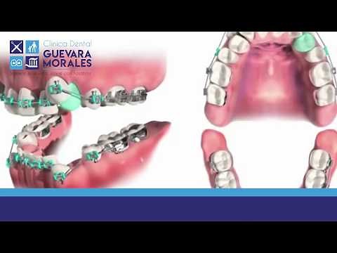 Extraccion de Premolares con Fines Ortodonticos