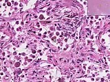 Organizing pneumonia - Histopathology - Lung • Video • MEDtube.net