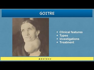 Goitre - Clinical features | Ethology/Causes | Types | Investigations | Treatment