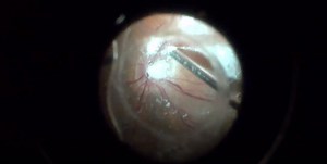 Severe Vitreoretinal Traction With Semi-Circular Retinal Detachment - Eyetube