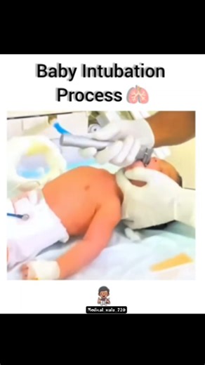 future doctor Jatin bansal 🫀🧠🩺 on Instagram: "Baby Intubation 🫁🏥 Baby intubation is placing a tube into a newborn's windpipe (trachea) to help them breathe, involving positioning the head, using a laryngoscope to find the vocal cords, guiding the tube in (usually 1-2 cm past), securing it, and confirming placement with chest rise, breath soun... . . . . #doctor #follow #followers #viral #thankyou"