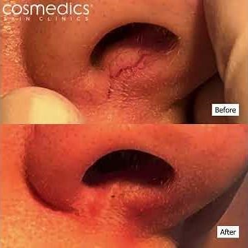 Nose thread vein removal treatment - watch them disappear!
