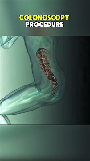Colonoscopy Procedure|3D ANIMATIONS| #Colonoscopy#ColonoscopyProcedure#ColonoscopyPrep#fyp