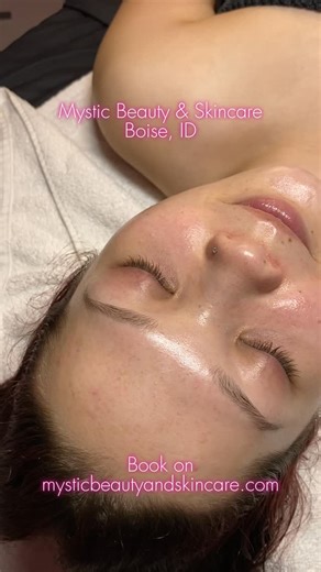 𝗠𝘆𝘀𝘁𝗶𝗰 𝗕𝗲𝗮𝘂𝘁𝘆 & 𝗦𝗸𝗶𝗻𝗰𝗮𝗿𝗲 | 𝗞𝗼𝗿𝗲𝗮𝗻 𝗦𝗸𝗶𝗻𝗰𝗮𝗿𝗲 𝗕𝘆 𝗟𝗮𝘂𝗿𝗮 on Instagram: "Before + after her Dermaplane Glow Facial ⋆ 𐙚 ̊. Dermaplaning instantly brightens your complexion by removing peach fuzz and exfoliating rough, dead skin. Paired with professional Korean skincare, dermaplaning reveals the ultimate glass-skin glow. Smooth, radiant, and unbelievably soft. 𖤓 Book yours with the link in my bio ⋆˙⟡ . . [kbeauty skincare, Korean skincare Boise, Boise skincare,