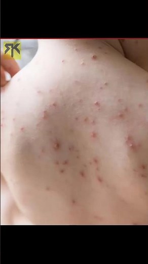 Chiken Pox
