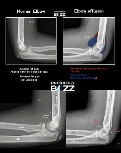 🦴 Elbow X-ray: Normal vs Elbow Effusion (Fat Pad Sign) 🩻 This lateral elbow radiograph beautifully demonstrates the difference between a normal elbow and elbow joint effusion. 🔍 Key Radiographic Findings: ✅ Normal Elbow Anterior fat pad lies flat within the coronoid fossa Posterior fat pad is not visible (normal finding) ⚠️ Elbow Effusion Elevated anterior fat pad Visible posterior fat pad Classic “Sail Sign” appearance ⛵ ➡️ Indicates joint effusion, commonly associated with occult fractures,