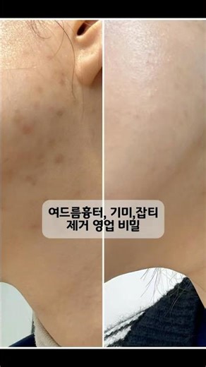 멜라닌색소. 색소침착 제거 꿀팁! 흉터밤 사용가이드