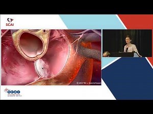 Why PFO Closure Is an Exciting Therapy
