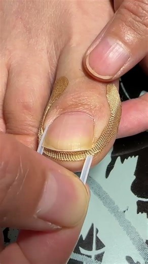 Ingrown Toenail Correction Foot Care Nail Treatment Shorts