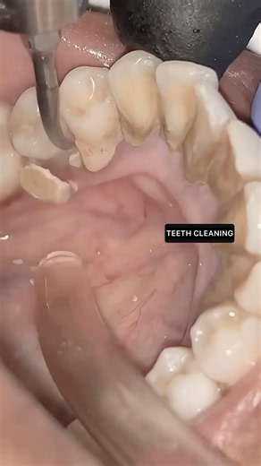 Satisfying Dental Cleaning ASMR #shorts #tartar