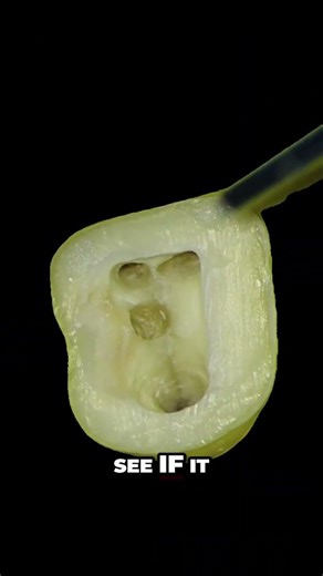 Biodentin Cavity Repair Demo 🕳️🦷