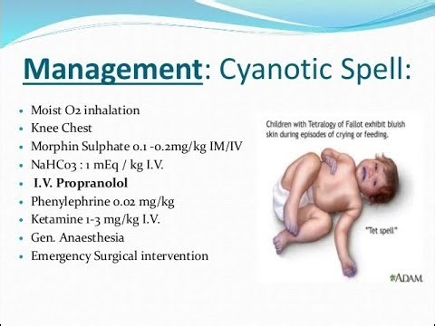 Treatment of Hypercyanotic spells Tet spells in Children - Tetralogy of Fallot