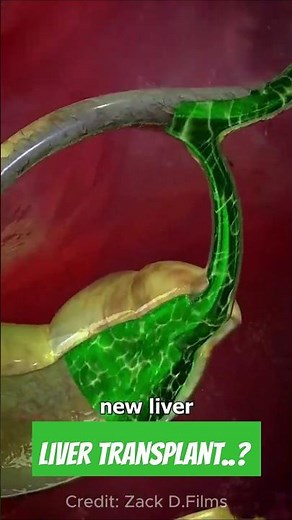 Liver Transplants Work || Transplants || Surgery