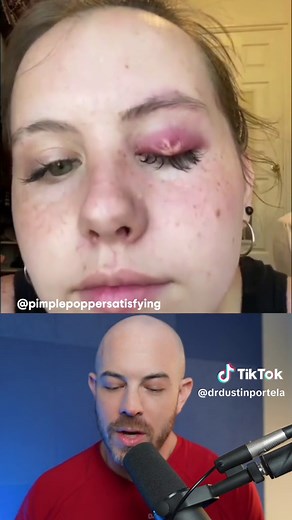 How to Treat a Giant Stye on Your Eye Safely