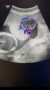 Placental chorioangioma #chorioangioma #placentaldis #ultrasoundmade | Ultrasound made easy