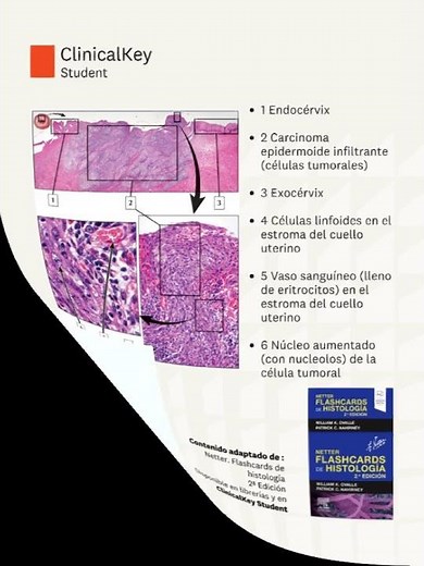 Todo lo que necesitas saber sobre el cáncer de cuello de útero