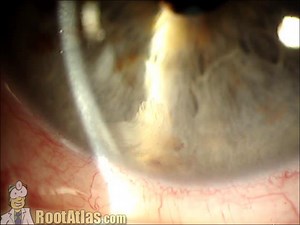 Retained lens material after cataract surgery (Video) - TimRoot.com