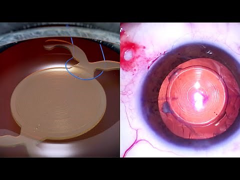 DISLOCATED TORIC MULTIFOCAL INTRAOCULAR LENS: 3D ANIMATION and STEP-BY-STEP EYE SURGERY