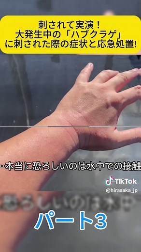 ハブクラゲに刺されたときの症状と応急処置