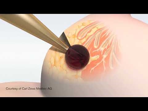 Intraoperative Radiation Therapy (IORT) at Loyola Medicine
