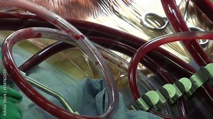 Heart-lung machine. Extracorporeal circulation unit