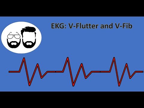 EKG Series: Ventricular Flutter (V-Flutter) and Ventricular Fibrillation (V-Fib)